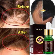 That doesn't mean you have to live with thinning. 100 Original 10ml Hair Loss Products Natural With No Side Effects Grow Hair Faster Regrowth Hair Growth Products Wish