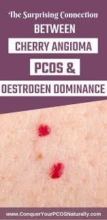 They are skin spots containing a deep red color which reflects the name and are normally not dangerous. The Surprising Connection Between Cherry Angioma And Pcos And Oestrogen Dominance Have You Noticed A Few Small Myster Estrogen Dominance Pcos Pcos Infertility