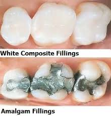 A composite filling is usually placed by a cosmetic or general dentist. Why Use Composite Fillings The Dental Spa