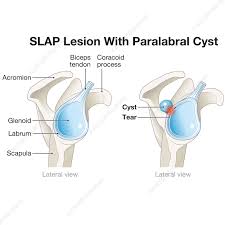 Image result for SLAP Lesion