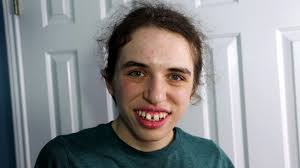 Daelyn is one of only a few people in recorded history diagnosed with her  ultra-rare genetic condition, a disorder of the FBXW11 gene. She  communicates by repeating lines from her favorite TV