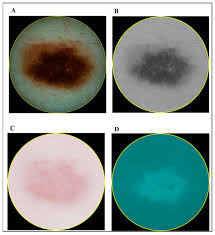 Diagnostics Free Full Text Diagnostics Of Melanocytic Skin Tumours By A Combination Of Ultrasonic Dermatoscopic And Spectrophotometric Image Parameters Html