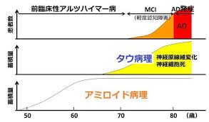 このアカウントには、性的興奮を催すリンクや破廉恥な画像を多数含みます。 もし嫌悪感を感じたらミュートないしはブロック下さい。 #uncensored #無修正 #pornstar #av女優. ã‚¢ãƒ«ãƒ„ãƒã‚¤ãƒžãƒ¼ç—…æ²»ç™‚ã«æ–°ãŸãªæ¨™çš„ãŒæµ®ä¸Š æ—¥çµŒãƒ¡ãƒ‡ã‚£ã‚«ãƒ«