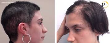 Un trapianto capillare”completamente non rasato”, che è una procedura in cui la rasatura dell'area donatrice per l'estrazione dei follicoli è totalmente . Trapianto Capelli Tecnica Micro Fue Costi Pallaoro Medical Laser