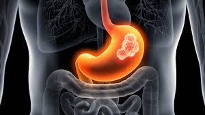 8 Síntomas Comunes del Cáncer Gástrico | Español Hartford HealthCare | CT