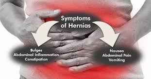 Image result for stomach hernia symptoms