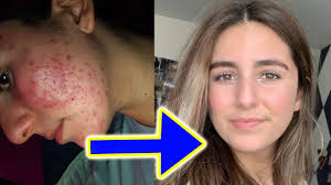 We did not find results for: One Of The Best Spot Medications Is It Worth A Try To Clear Bad Acne
