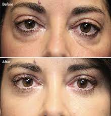 Laser Treatments For Dark Circles Are They Worth It Before Afters Cost