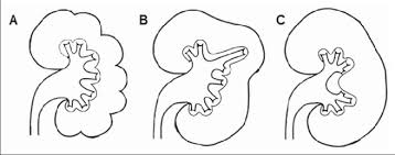 Arabian camels, also known as dromedaries, have only one hump, but they employ it to great effect. Lobar Anatomy Abnormalities Schematic Illustration Of Persistent Fetal Download Scientific Diagram