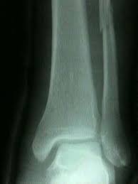 A pilon fracture, also called a plafond fracture, is a fracture of the distal part of the tibia, involving its articular surface at the ankle joint. Maisonneuve Fracture Wheeless Textbook Of Orthopaedics
