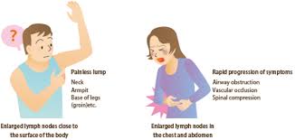 Image result for Lymphoma