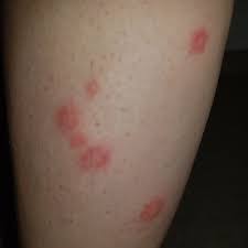 Image result for mite bites on humans