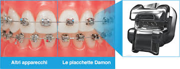 113 752 просмотра 113 тыс. Apparecchi Ortodontici Damon Ortodonzia Marelic
