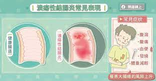 For faster navigation, this iframe is preloading the wikiwand page for 潰瘍性大腸炎. é©š è…¸ å‡ºç‹€æ³ æ½°ç˜æ€§çµè…¸ç‚Žå¥½æŽƒèˆˆ Pansci æ³›ç§'å­¸