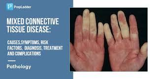 Image result for Connective Tissue Disorder