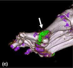 However, myelolipomas, cysts, hemorrhage, pheochromocytomas, metastases, and adrenocortical carcinomas are also possible. Material Decomposition With Dual And Multi Energy Computed Tomography Mrs Communications Cambridge Core