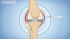 Les Infiltrations De Corticoides Ou De Viscosupplements Pour Les Articulations Arthrosiques Arthrolink