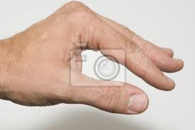 In diesen fällen entwickeln betroffene eine. Krankheitsverlauf Neurodermitis Hand Dalich Freigestellt 654 Fototapete Fototapeten Ekzem Dermatologischen Cracky Myloview De