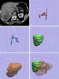 Kidneys are dark brown in colour and are embedded in a mass of fat. Preoperative Hepatic 3d Models Virtual Liver Resection Using Three Dimensional Imaging Technique European Journal Of Radiology