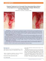 Una gran selección de jovencitas/viejos películas xxx. Pdf Surgical Treatment Of A Cemental Tear Associated Bony Defect Using Hyaluronic Acid And A Resorbable Collagen Membrane A 2 Year Follow Up