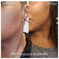 With the advent of new lasers, it doesn't hurt—a lot. Laser Hair Removal For The Face Romeo Juliette Laser Hair Removal