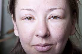 Quincke S Edema Quincke S Disease Angioedema