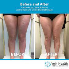 Pin On Varicose Veins