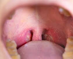 Why do i get whitish discharge from my tonsils? White Spot On Tonsils Causes How To Get Rid Of These White Spots