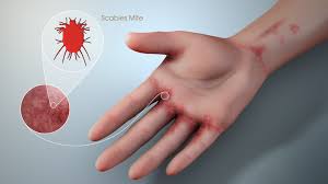 Image result for scabies symptoms