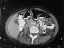 About 1% of colon polyps will become colon cancer. Imaging Findings Of Right Colon Diverticulitis That Mimics Colon Cancer A Case Report Cases Journal Full Text