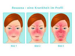 Ebenfalls von rosacea betroffene männer und frauen berichten von ihren eigenen erfahrungen mit verschiedenen formen von rosacea. Rosazea Die Angst Vorm Rotwerden Gesundheit