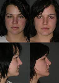 Buccal Fat Extraction - Wikipedia