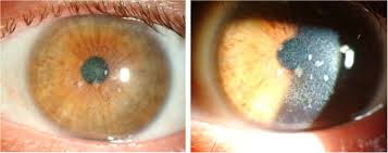 Corneal Haze Is A Cloudy Layer In The Eye