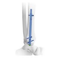 Distal Tibial Fracture,DTN Distal Tibial Nail ,Medical ...