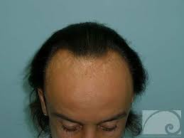 Più di 20 anni di esperienza nel trapianto capelli a torino · dr. Autotrapianto Rivalta Di Torino Autotrapianto Dei Capelli Con Tecniche Fue E Fut Rivalta Di Torino La Soluzione Per Il Trapianto Di Capelli Per Chi Abita A Rivalta Di Torino Autotrapianto Capelli