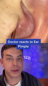 Ear Pimple Pop Compilation: Dermatologist Reacts to Pimple Popping Videos