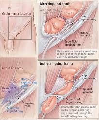 Related online courses on physioplus. A Groin Hernia Is A Weakness In The Muscles And Tissues Of The Groin In 2021 Medical Anatomy Medical Knowledge Groin Hernia In Men