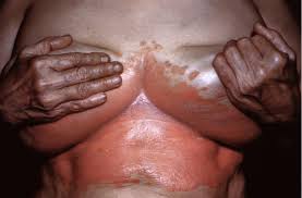 Image result for Candidiasis under breasts