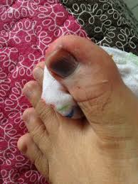 Biasanya mereka yang mempunyai masalah sakit tapak kaki akan terasa tegang di bahagian ini. Ambrynaa S Photo Diary Kemalangan Dalam Rumah Tulang Ibu Jari Retak