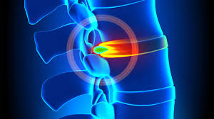 A slipped disc or disc herniation, happens when the tough, outer layer of the disc weakens or tears, allowing soft material from the inside to slip out. Common Bulging Disc Symptoms In Your Lower Back