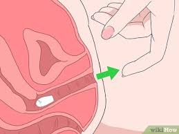 Sep 29, 2020 · if your doctor has prescribed vaginal suppositories, you may be wondering how they work. How To Insert Progesterone Suppositories Without An Applicator