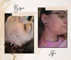 Any Micro-needling/dermapan/micro-dermabrasion facial offers in the area  please? Thanks