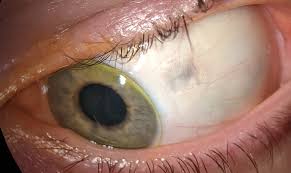 Image result for lesion sclera