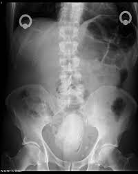 Butt plug xray