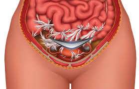 Check spelling or type a new query. Kesakitan Dan Masalah Selepas Seksyen Cesarean 20 Gambar Sakit Belakang Endometriosis Dan Endometritis Hernia Bagaimana Melegakan Kesakitan Dan Penggunaan Ubat Penahan Sakit Hematoma Dan Fistula