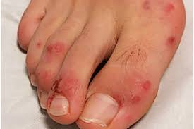 Vaping hives during the covid. Covid Toes Rashes How The Coronavirus Can Affect Your Skin