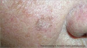 Of course, your specialist is the main person whose advice you should follow but it doesn't do anyone harm. Skin Cancer Pictures Photos Pictures Of Skin Cancer