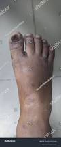 Image result for Koilonychia feet