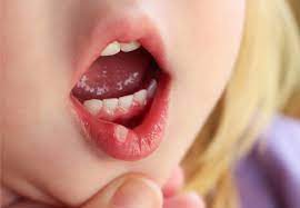 They can still become infected, though, so getting the right medical care is important. Mouth Ulcers Hse Ie