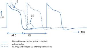 Image result for Extrasystole